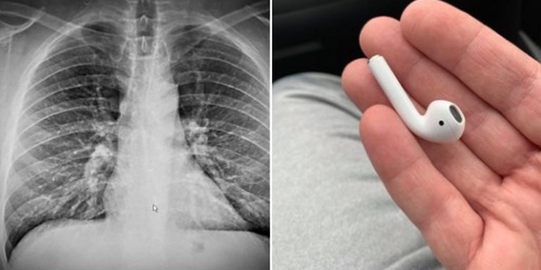Sentía molestias en el pecho, se tragó un AirPod mientras dormía