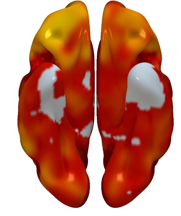 El riesgo cardiovascular y el declive cerebral se asocian en la mediana edad 2 El riesgo cardiovascular y el declive cerebral se asocian en la mediana edad 2