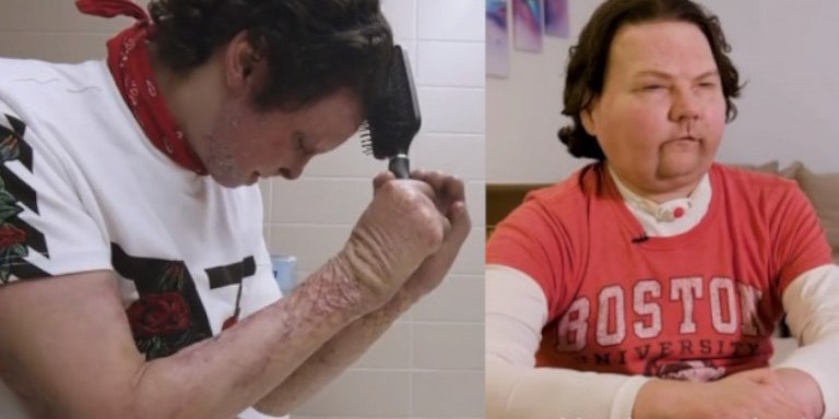 VIDEO. Joven de 22 años: el primero en recibir trasplante de cara y de ambas manos 1 joven trasplante