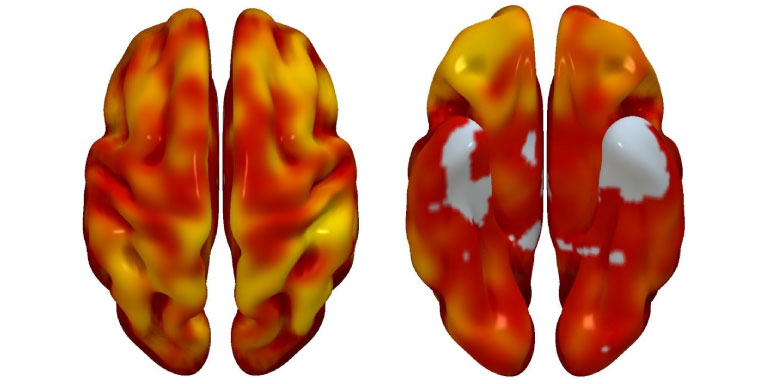 El riesgo cardiovascular y el declive cerebral se asocian en la mediana edad 1 riesgo cardiovascular