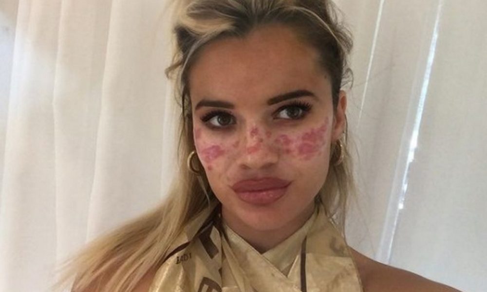 Influencer sufrió quemaduras en la cara por probar truco de belleza de TikTok