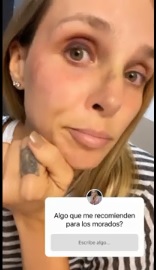 ¿Le pegaron? Elizabeth Loaiza mostró un moretón en el ojo tras, según dijo, golpearse en el baño 2 Elizabeth Loaiza