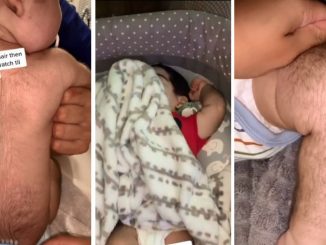 'Bebé lobo', madre explicó por qué su bebé tiene el cuerpo cubierto de vello 1 bebe lobo madre explico cuerpo vello