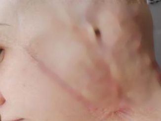 ¡Qué dolor! A una joven se le enredó el cabello en un taladro, perdió una oreja 1 joven
