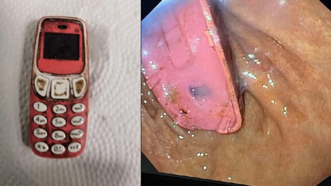 Hombre se tragó un celular Hombre se tragó un celular