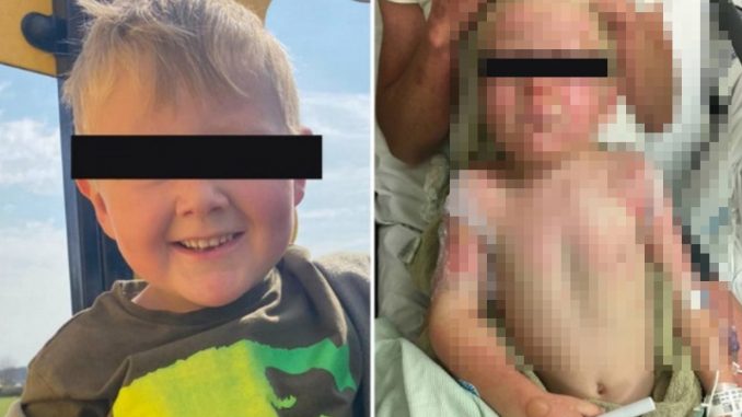 niño quemado baño espuma