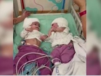 Separan con éxito a dos siamesas unidas por la cabeza 1 siamesas unidas por la cabeza