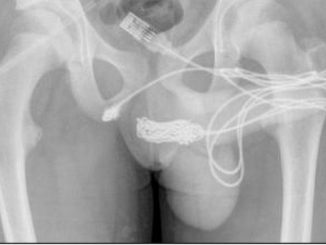 ¡Qué dolor! Joven se introdujo un cable USB por la uretra como una "experimentación sexual" 1 joven