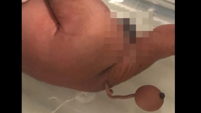 Tan raro, un bebé en Brasil nació con cola Tan raro, un bebé en Brasil nació con cola