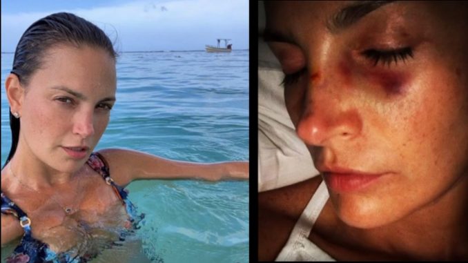 Juliana Galvis foto aparece golpeada 2021