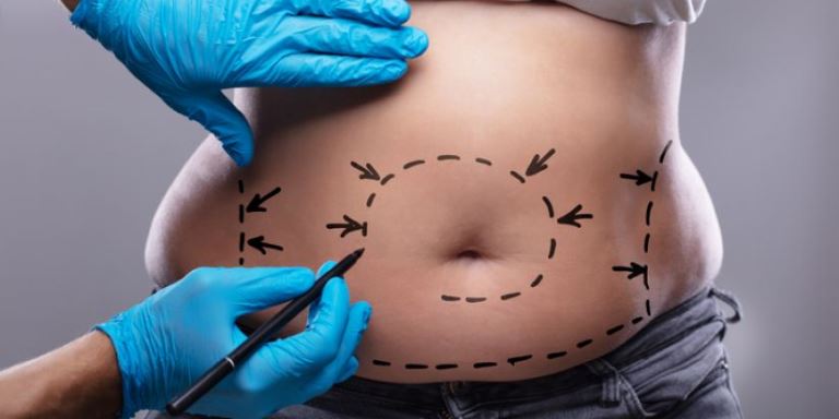 Imputan a estudiante de Medicina por muerte de una mujer a causa de liposucción 1 liposuccion