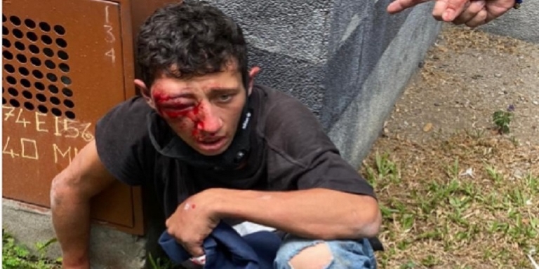 ¿Karma? Hombre que estaba robando por La 33, fue picado por una avispa en el ojo 1 ladron 3