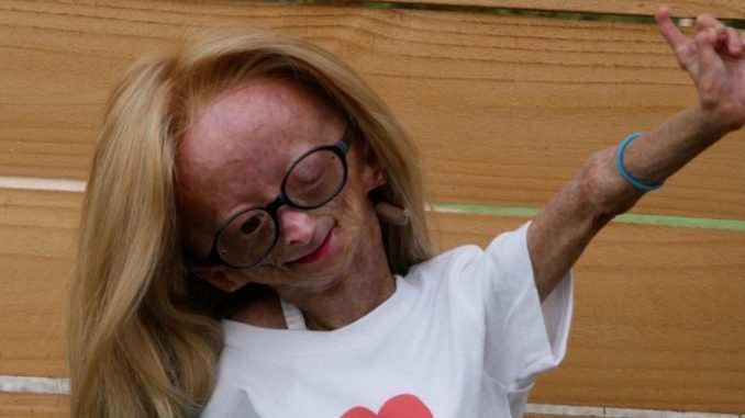 Murió Adalia Rose, la youtuber que padecía la enfermedad de Benjamin Button4