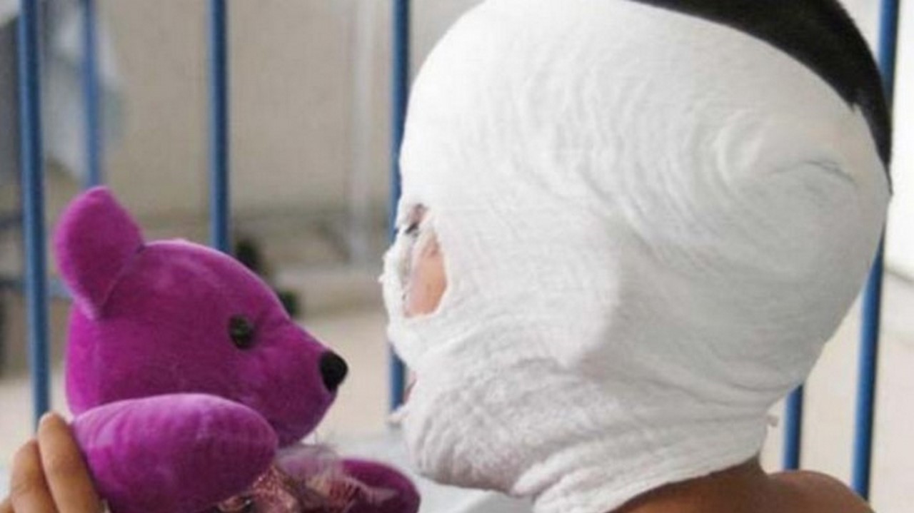 Prendió fuego a su pareja y la dejó gravemente herida: familia asegura que “se le cayó toda la piel”