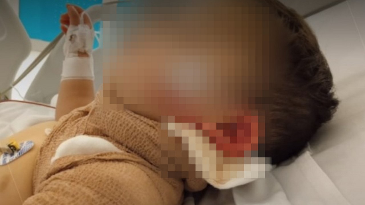 Niño se quemó con agua hirviendo en jardín infantil