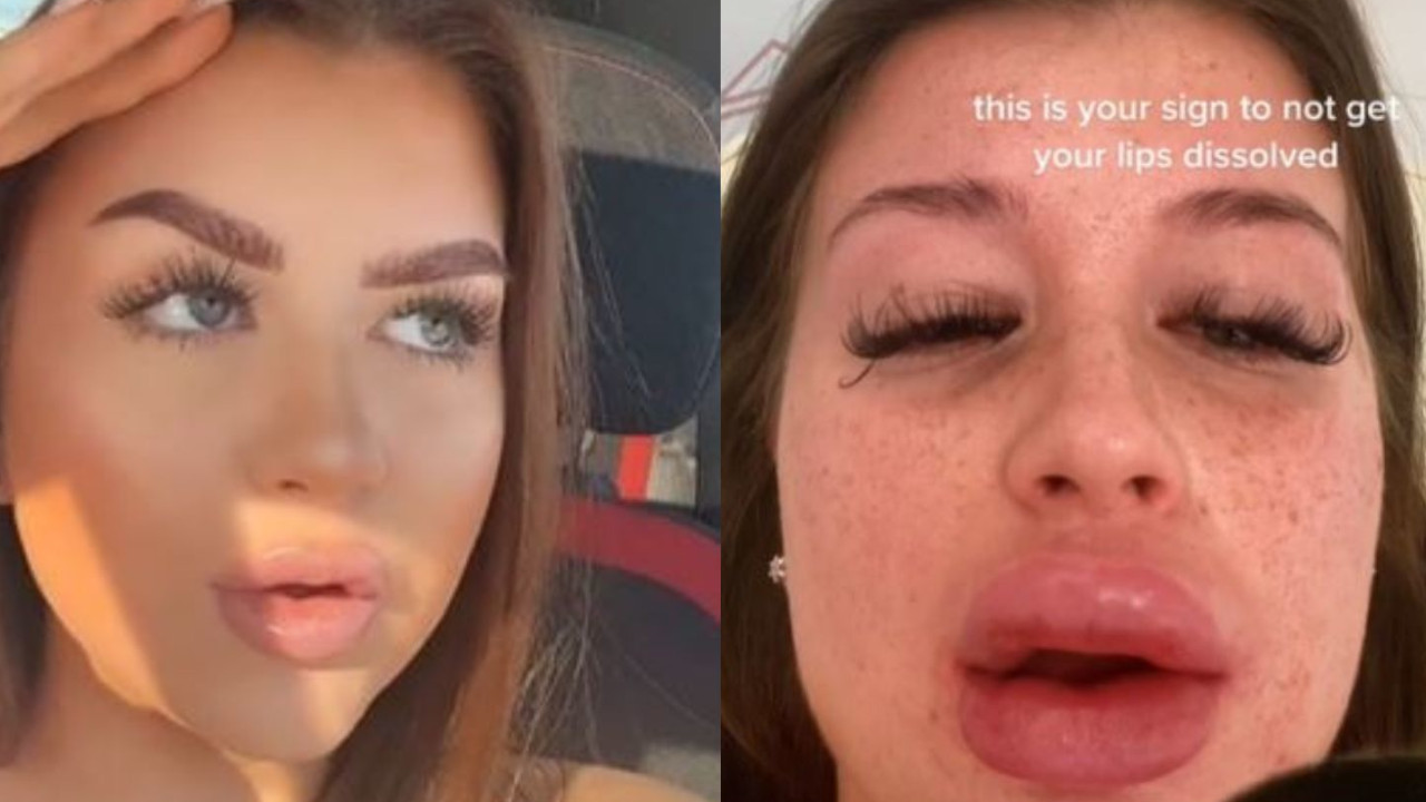 Modelo se desfiguró el rostro luego de inyectarse ácido hialurónico sintético en los labios