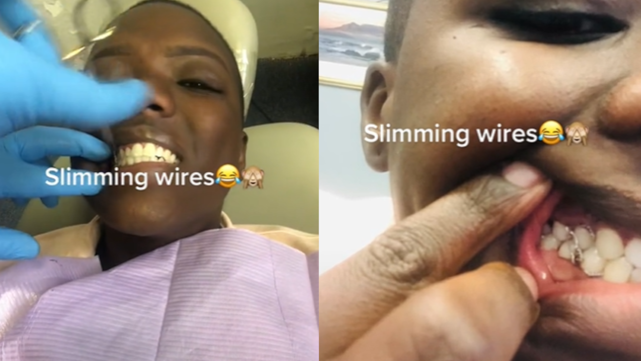 Tendencia donde mujeres se unen los dientes con alambre para no comer y adelgazar