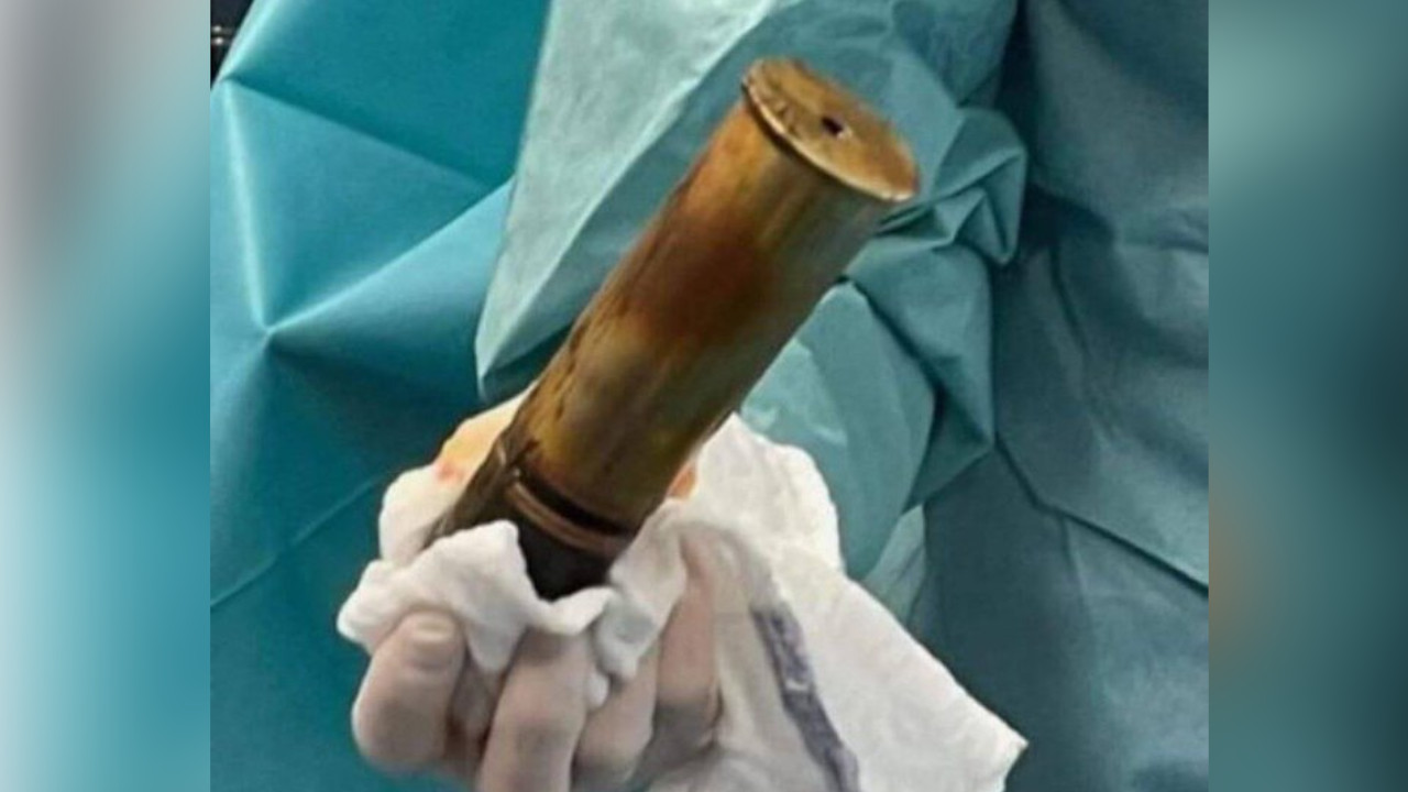 Evacuan hospital tras la llegada de un anciano con un misil en el ano