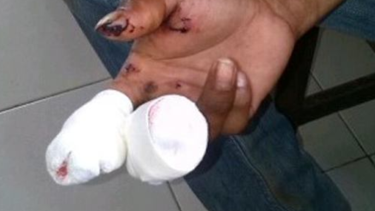 hombre de 36 años con amputación y fractura de dedos de la mano provocadas por tacos.