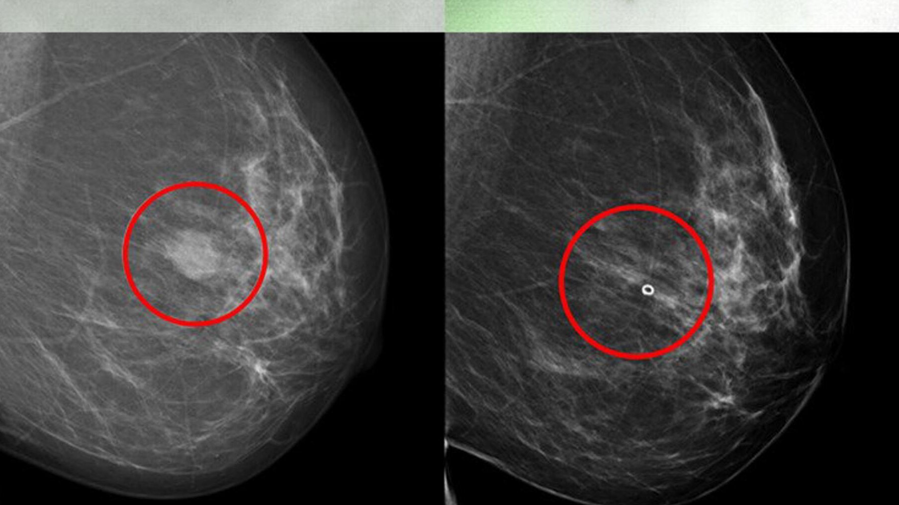 Cáncer de mama: nuevo método para buscar el mejor fármaco para cada paciente