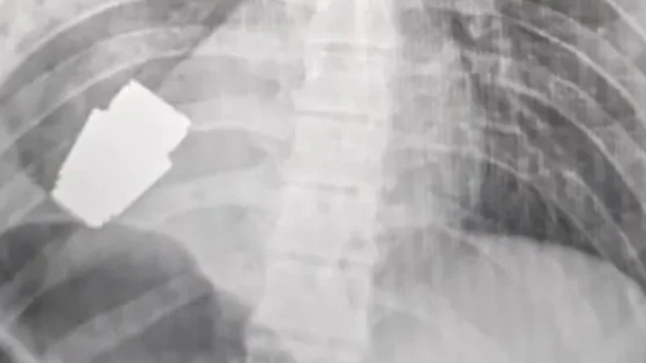 ¡Un milagro! retiran con éxito granada del pecho a un soldado ucraniano