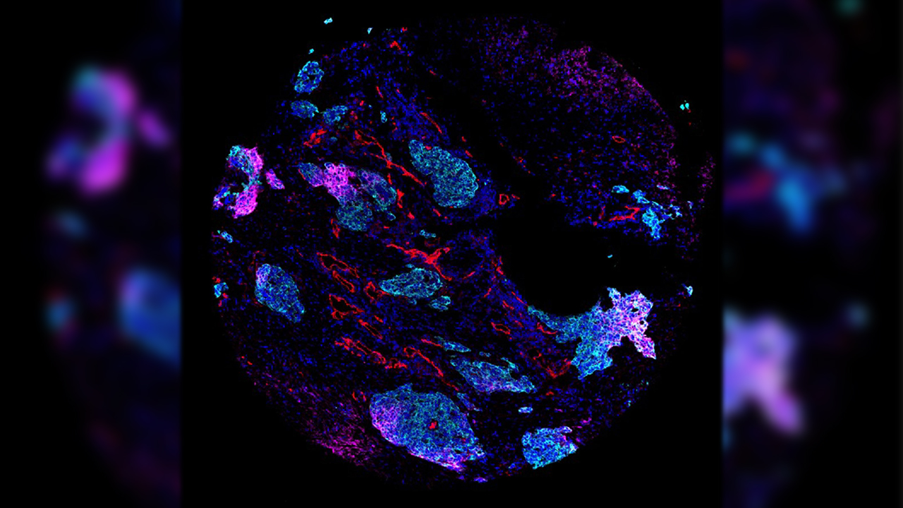 El mapa más amplio del cáncer de pulmón pone el foco en la diversidad tumoral