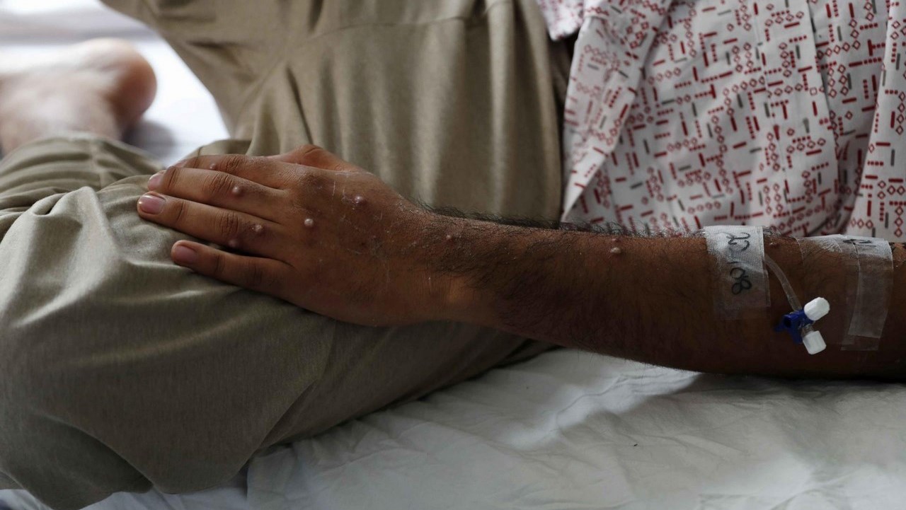 La OMS levanta la emergencia internacional por la viruela símica tras 10 meses de alerta