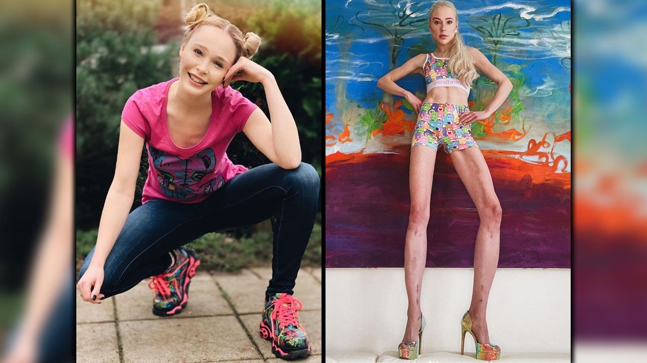 Una modelo se somete a una operación para alargarse las piernas y se gasta 148.000 euros