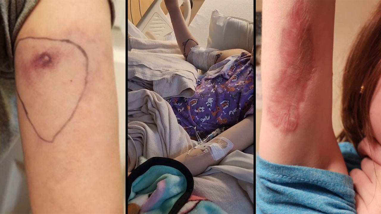 VIDEO. Pensó que su hija tenía una alergia pero fue mordido por una araña