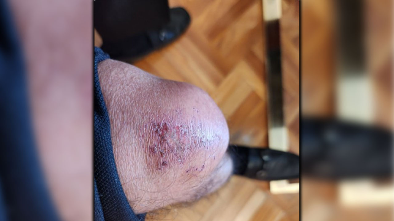 Petro mostró el rapón tras la fuerte caída en Cartagena