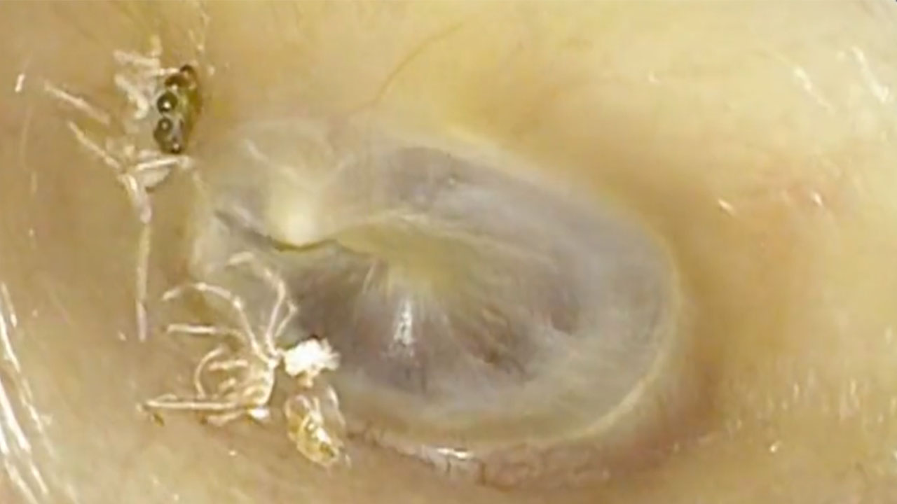 Encontraron una araña en el oído de una mujer