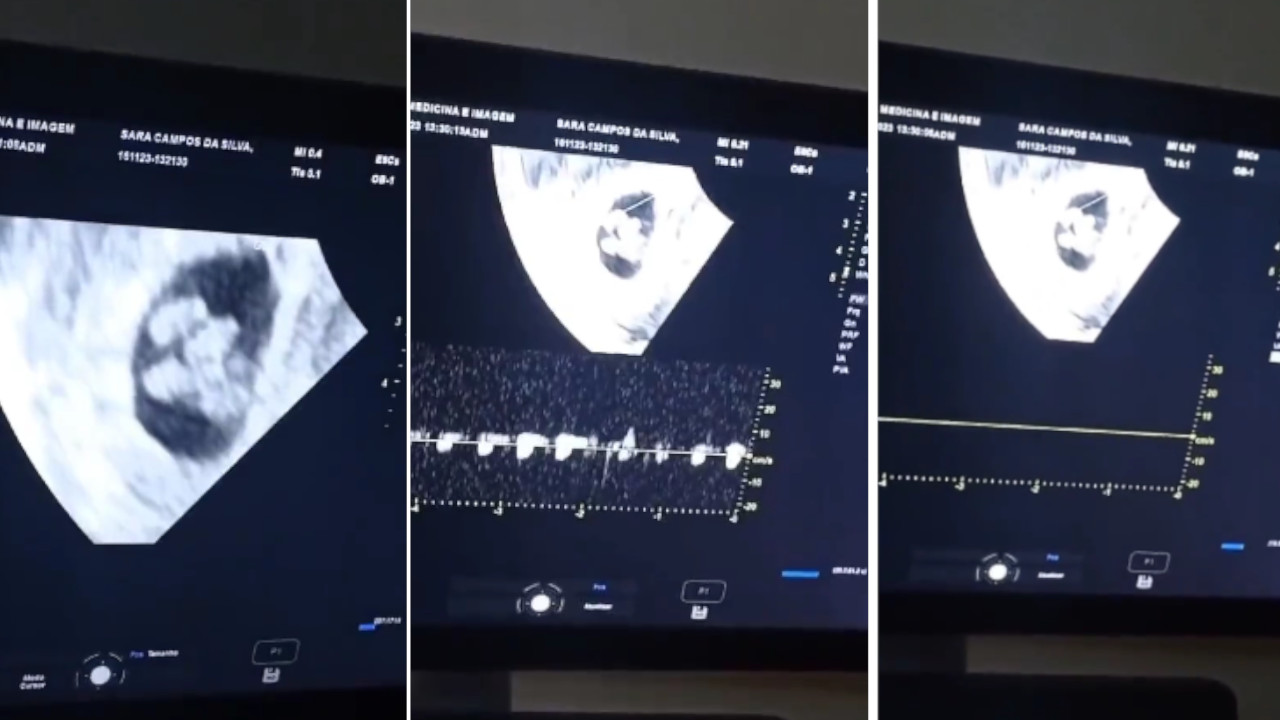 Joven de 18 años espera quintillizos en su primer embarazo