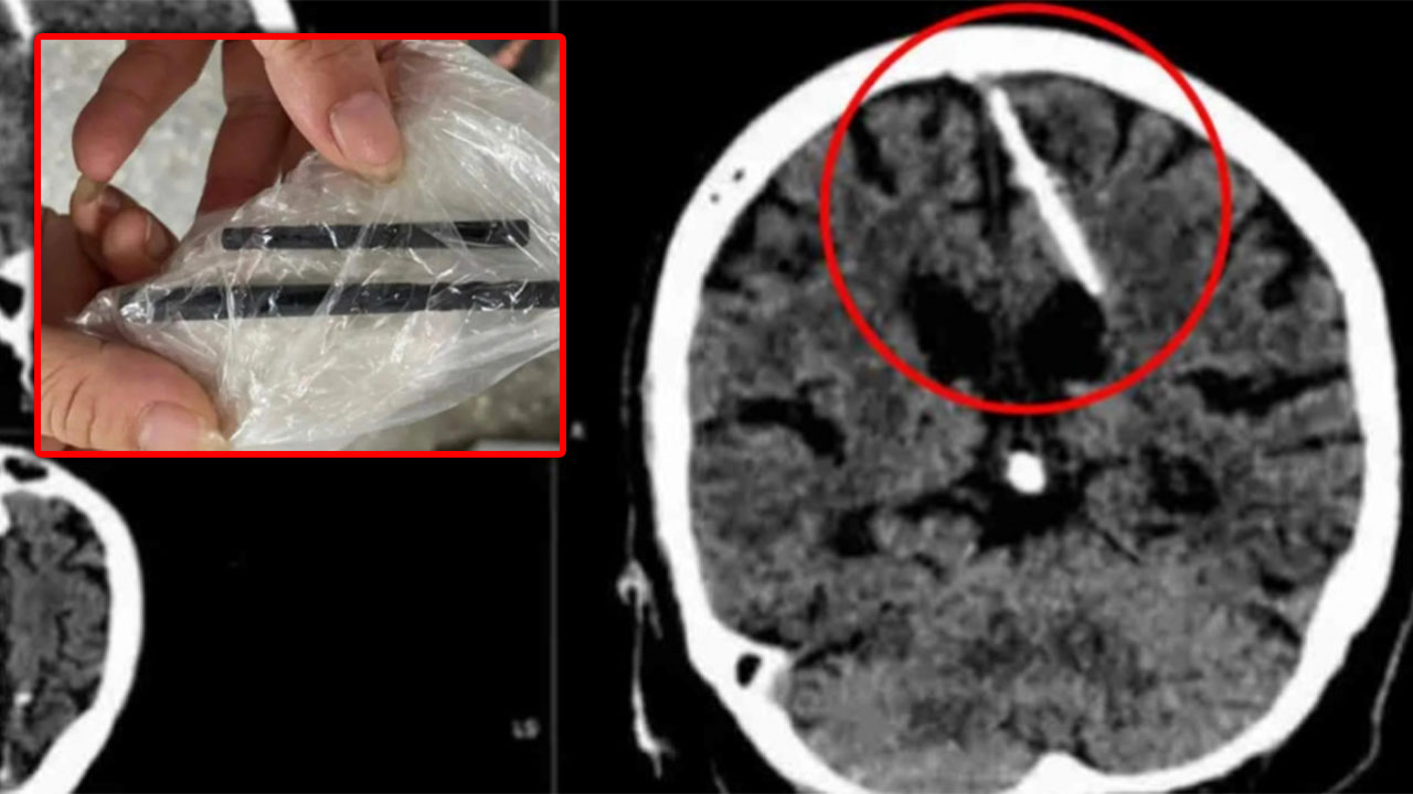 Hallaron palillos incrustados en su cerebro