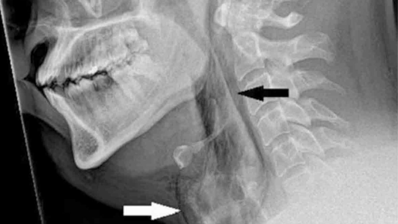 Hombre se desgarró la tráquea por aguantar estornudo