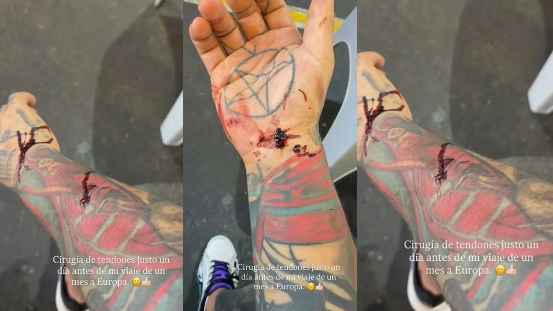 ¿Mala racha? Tras su accidente en el Amazonas, Yeferson Cossio deberá someterse a cirugía por lesión en el brazo